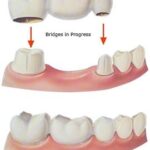 600_crown-bridges